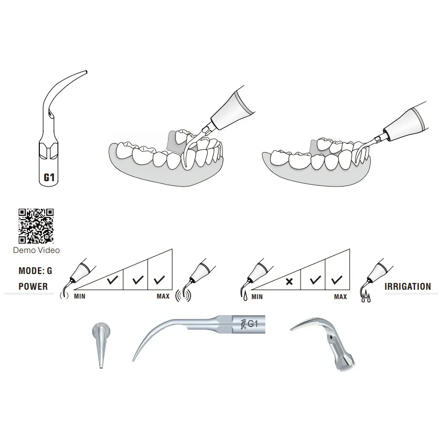 G1 Woodpecker Scaler Tip, Removal of Supragingival Deposits