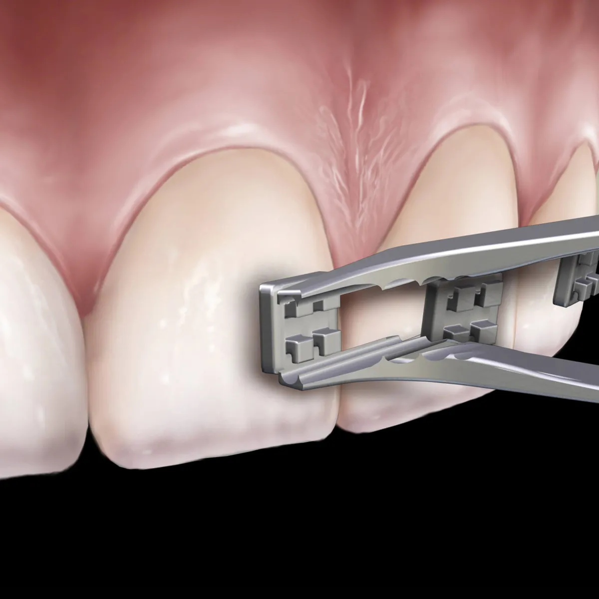Slim Direct Bond Bracket Holding Tweezer