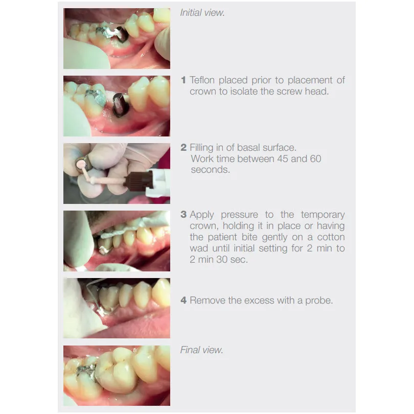 Dentotemp Long-Term Temporary Cement (Up to 6+ Months)