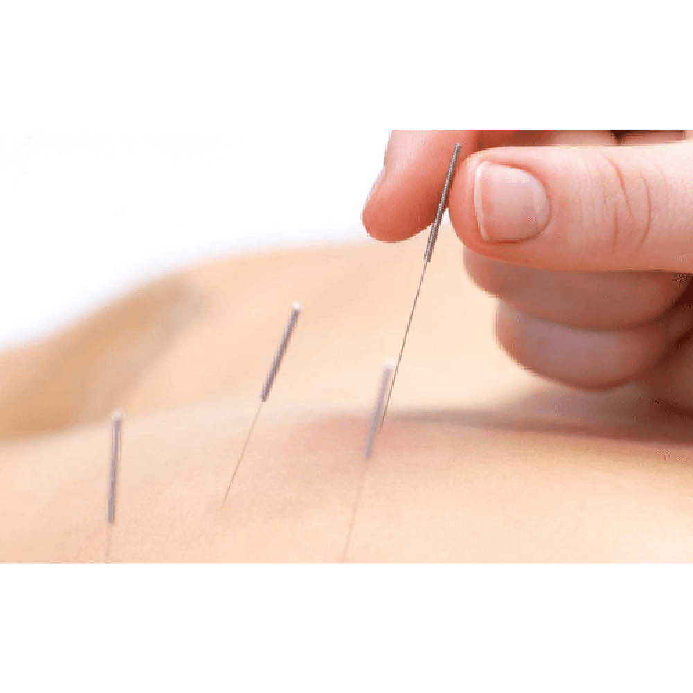 إبر جافة للعلاج الطبيعي – Dry Needling Needles معقمة (100 إبرة)